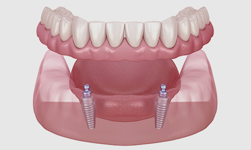 Denture Secure Grey