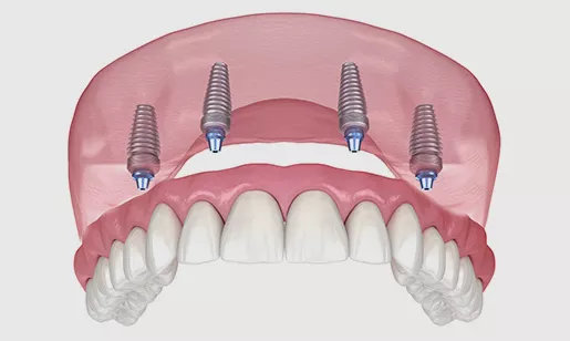 Fixed Denture full arch with 4 implants Diagram