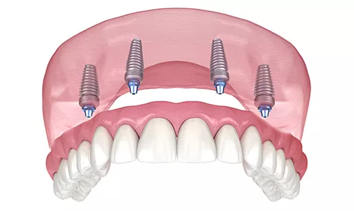 Fixed full top arch denture with four dental implants