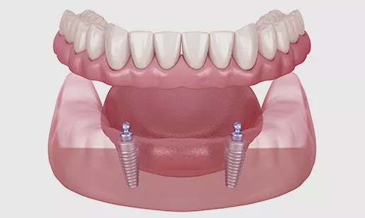 Denture Secured on two implants Diagram