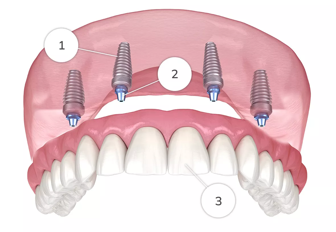 Fixed Denture Diagram