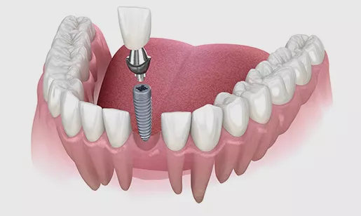Single Tooth Implant diagram