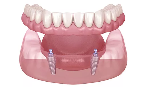 Implant dentures supported with two implants