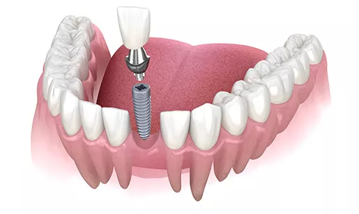 Single Tooth Implant diagram